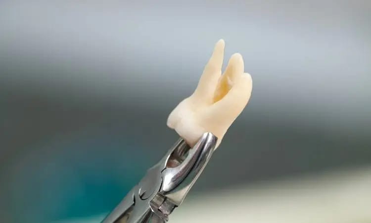 Tooth Extraction Image